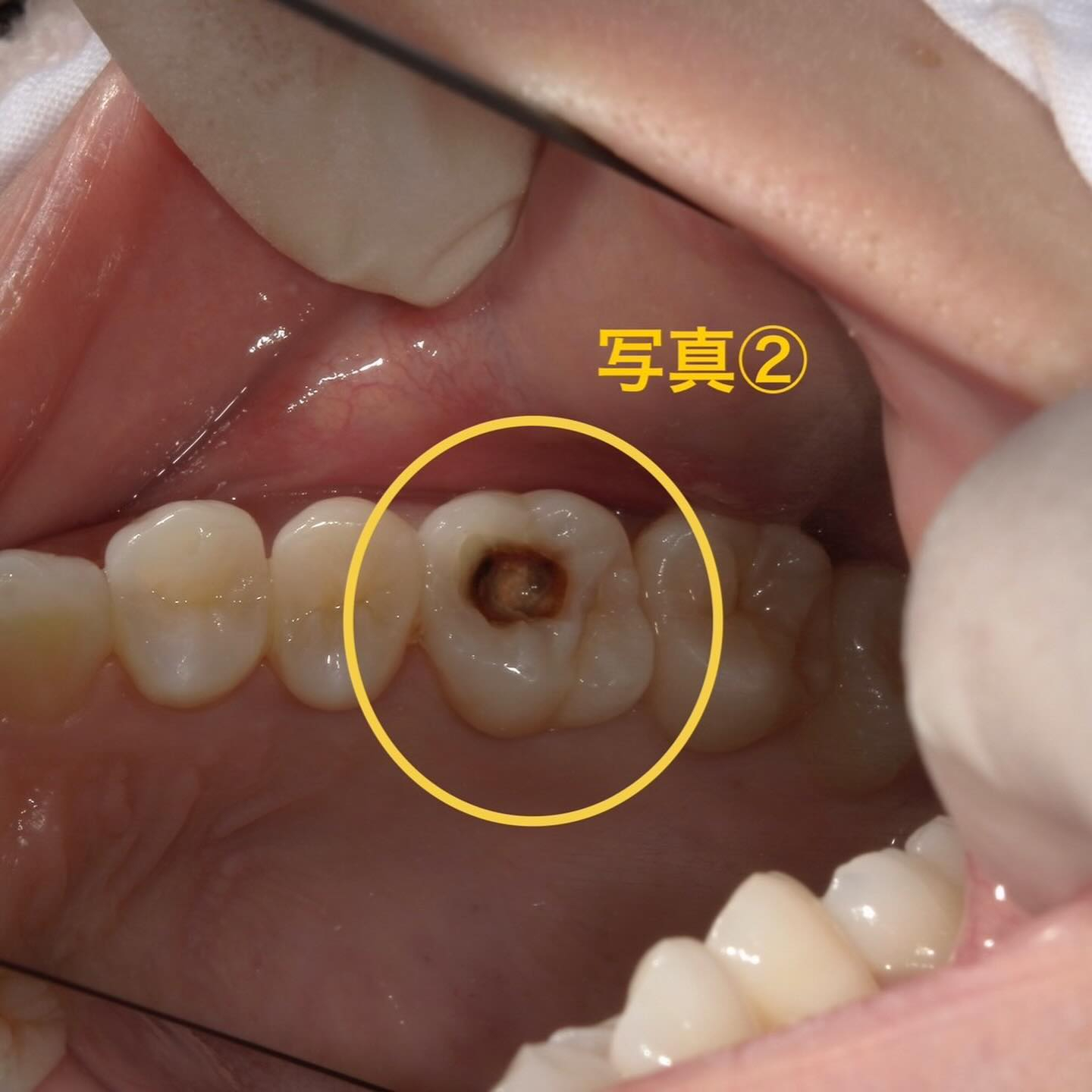 虫歯治療→神経の処置(抜髄)へ移行した方の症例写真をお見せし...
