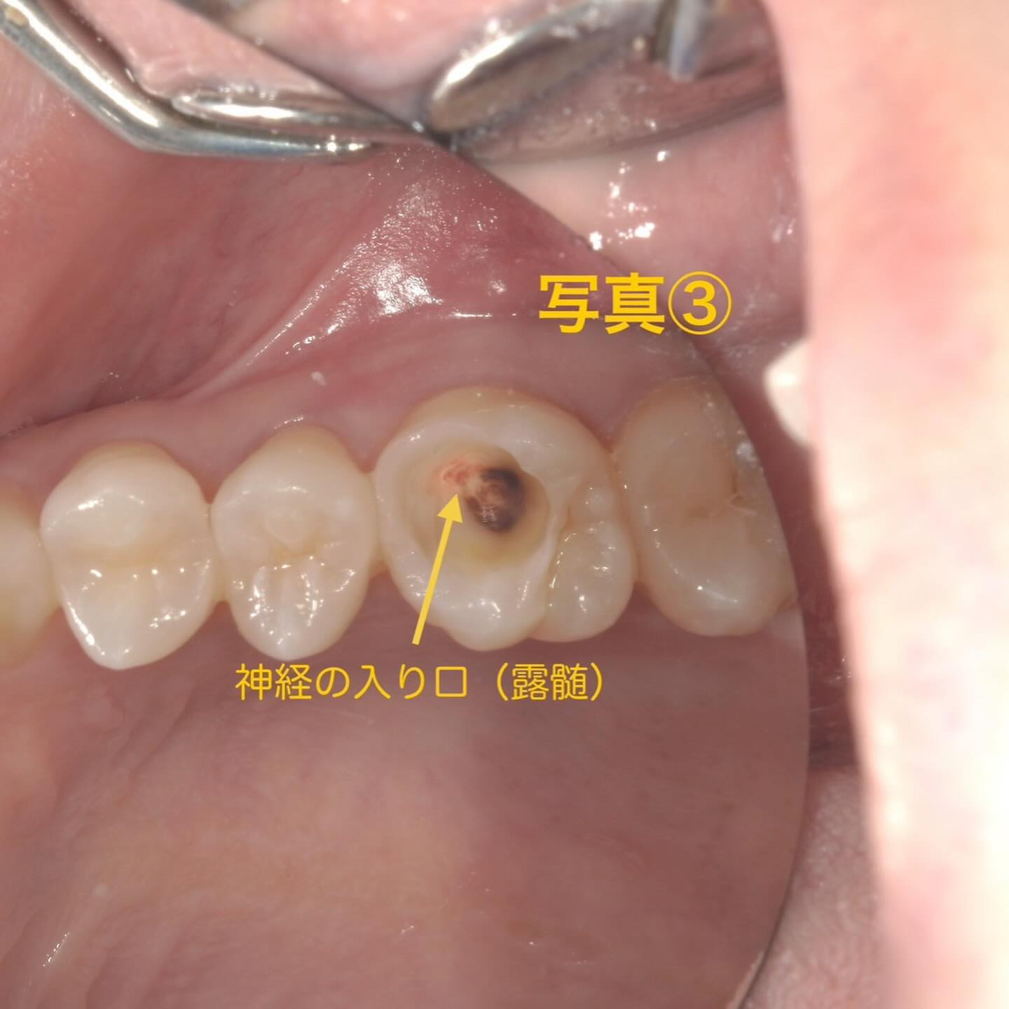 虫歯治療→神経の処置(抜髄)へ移行した方の症例写真をお見せし...