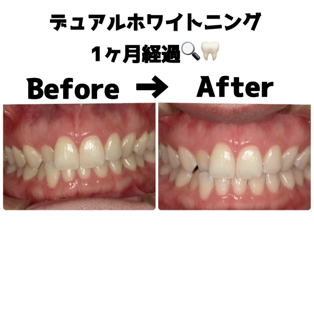 オフィスホワイトニング１回の後、ホームホワイトニングを行って...